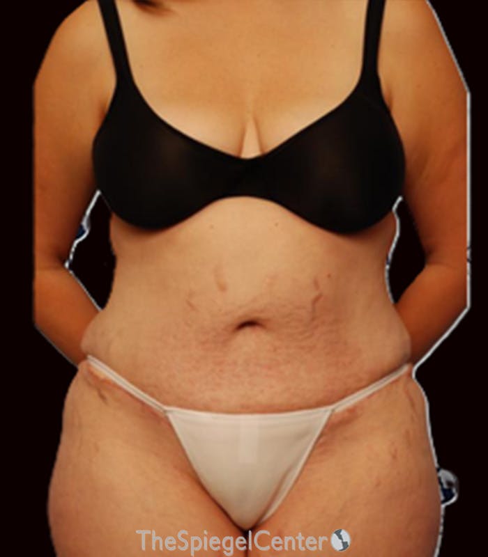 Tummy Tuck Before & After Gallery - Patient 152496 - Image 2