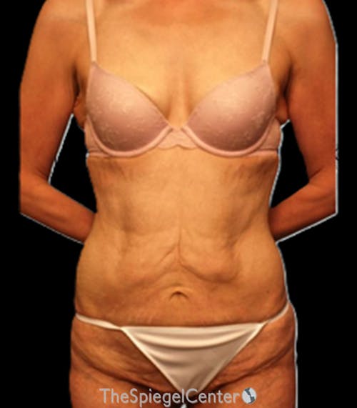 Tummy Tuck Before & After Gallery - Patient 206441 - Image 1