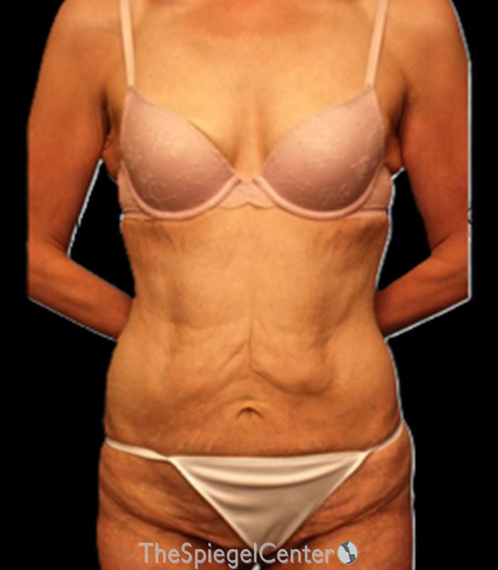 Tummy Tuck Before & After Gallery - Patient 206441 - Image 1