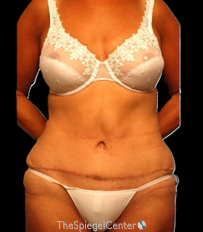 Tummy Tuck Before & After Gallery - Patient 123687 - Image 2