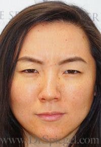 Botox / Dysport / Jeuveau / Xeomin Before & After Gallery - Patient 370882 - Image 2