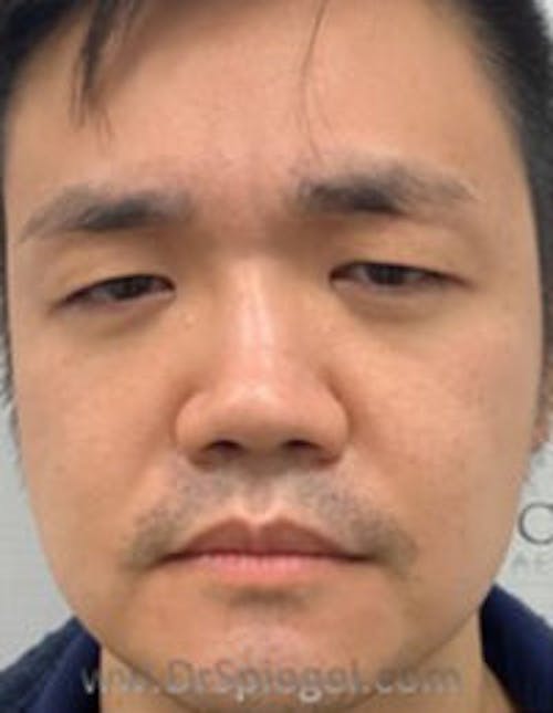 Botox / Dysport / Jeuveau / Xeomin Before & After Gallery - Patient 309521 - Image 2