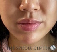 Chin Filler Before & After Gallery - Patient 103523 - Image 2