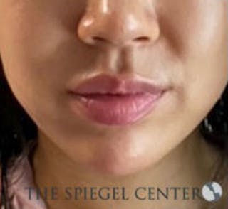Chin Filler Before & After Gallery - Patient 103523 - Image 2