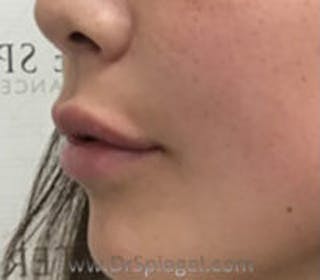 Lip Filler Before & After Gallery - Patient 409792 - Image 4