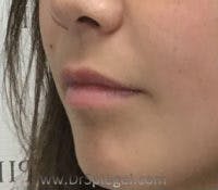 Lip Fillers Before & After Gallery - Patient 221086 - Image 3
