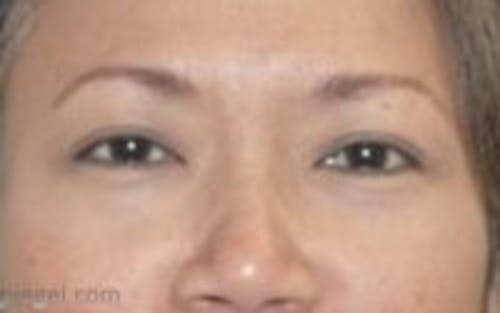 Monolid/Double Eyelid Surgery Before & After Gallery - Patient 768714 - Image 2