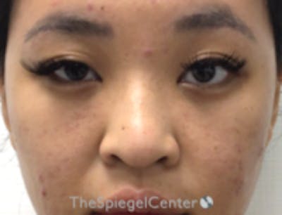 Non-Surgical Rhinoplasty / Nose Filler Before & After Gallery - Patient 345584 - Image 1