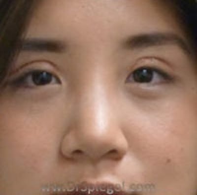 Non-Surgical Rhinoplasty / Nose Filler Before & After Gallery - Patient 101026 - Image 1
