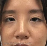 Non-Surgical Rhinoplasty / Nose Filler Before & After Gallery - Patient 101026 - Image 2