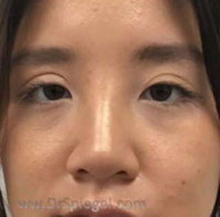Non-Surgical Rhinoplasty / Nose Filler Before & After Gallery - Patient 101026 - Image 2