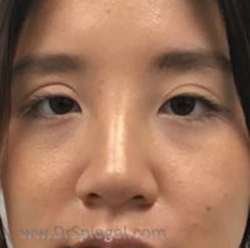 Non-Surgical Rhinoplasty / Nose Filler Before & After Gallery - Patient 101026 - Image 2