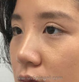 Non-Surgical Rhinoplasty / Nose Filler Before & After Gallery - Patient 101026 - Image 4