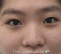 Non-Surgical Rhinoplasty / Nose Filler Before & After Gallery - Patient 212825 - Image 1