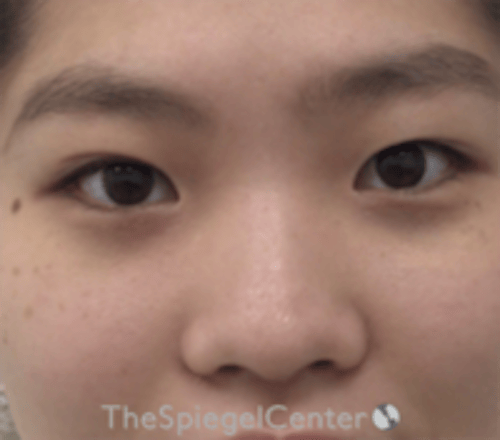 Non-Surgical Rhinoplasty / Nose Filler Before & After Gallery - Patient 212825 - Image 1