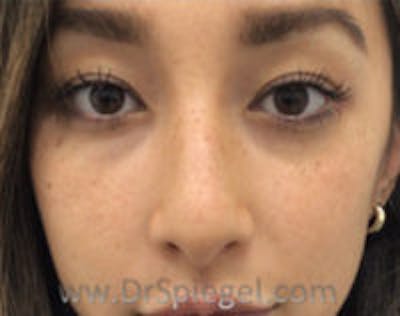 Non-Surgical Rhinoplasty / Nose Filler Before & After Gallery - Patient 429301 - Image 1