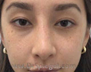 Non-Surgical Rhinoplasty / Nose Filler Before & After Gallery - Patient 429301 - Image 2