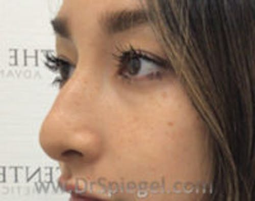 Non-Surgical Rhinoplasty / Nose Filler Before & After Gallery - Patient 429301 - Image 3