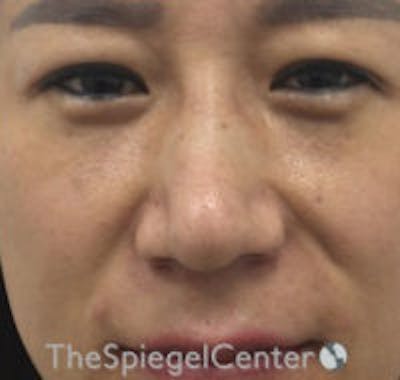 Non-Surgical Rhinoplasty / Nose Filler Before & After Gallery - Patient 223170 - Image 1