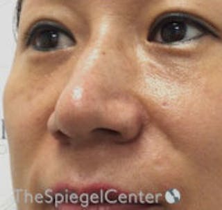 Non-Surgical Rhinoplasty / Nose Filler Before & After Gallery - Patient 223170 - Image 4