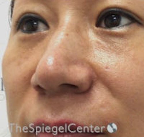 Non-Surgical Rhinoplasty / Nose Filler Before & After Gallery - Patient 223170 - Image 4