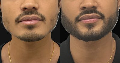 Hair Restoration Before & After Gallery - Patient 100861 - Image 1