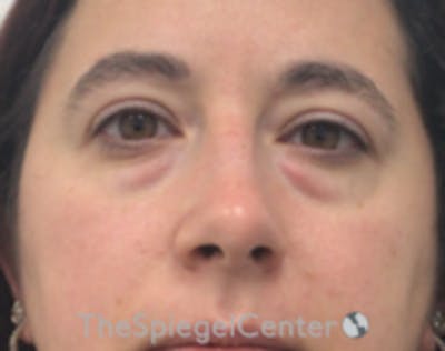 Blepharoplasty Before & After Gallery - Patient 264571 - Image 1