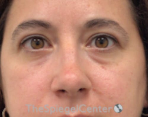 Blepharoplasty Before & After Gallery - Patient 264571 - Image 2