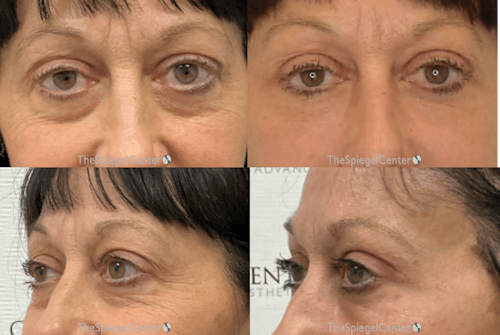 Blepharoplasty Before & After Gallery - Patient 309162 - Image 1