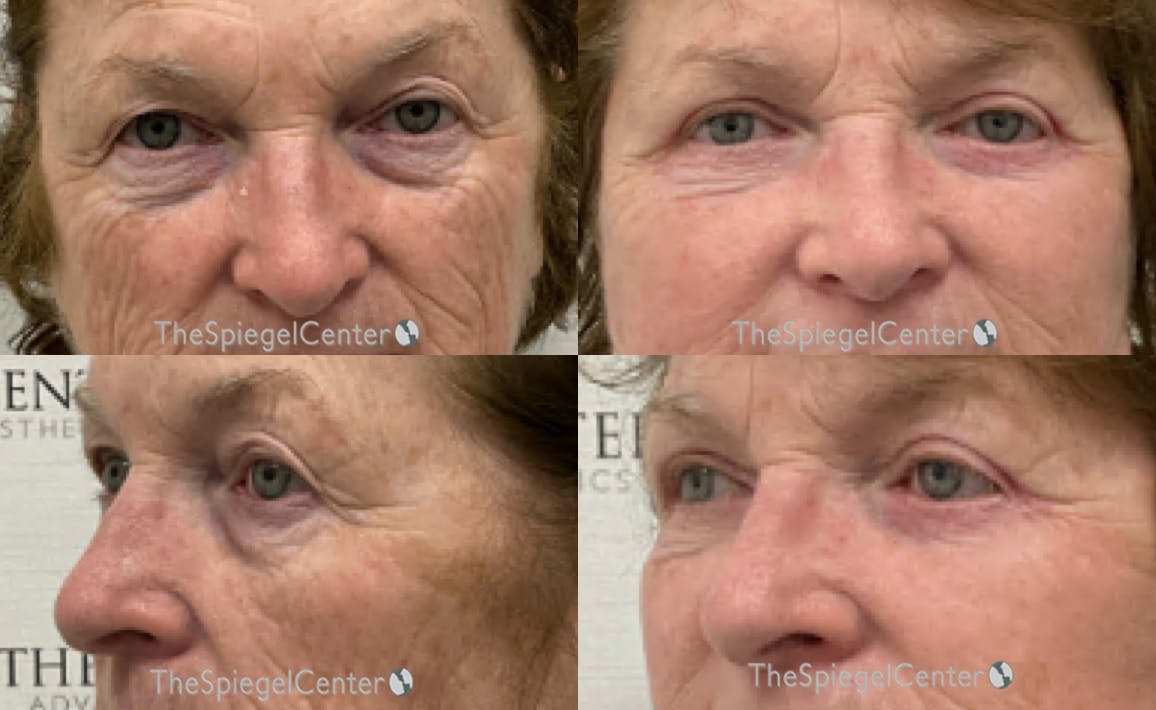 Blepharoplasty Before & After Gallery - Patient 386128 - Image 1