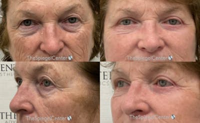 Blepharoplasty Before & After Gallery - Patient 386128 - Image 1