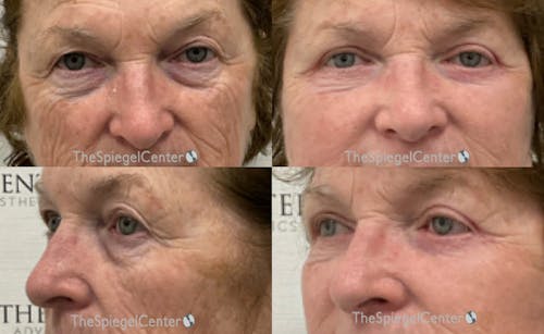 Blepharoplasty Before & After Gallery - Patient 386128 - Image 1