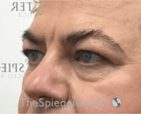 Blepharoplasty Before & After Gallery - Patient 932050 - Image 3