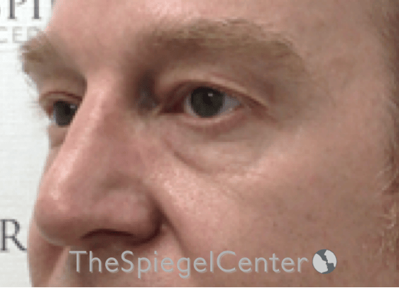 Blepharoplasty Before & After Gallery - Patient 331133 - Image 3