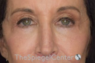 Blepharoplasty Before & After Gallery - Patient 809555 - Image 2