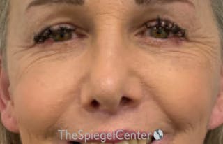 Blepharoplasty Before & After Gallery - Patient 231432 - Image 2