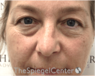 Blepharoplasty Before & After Gallery - Patient 331593 - Image 1