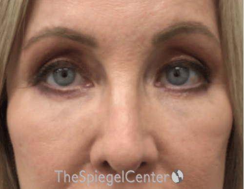 Blepharoplasty Before & After Gallery - Patient 163417 - Image 2