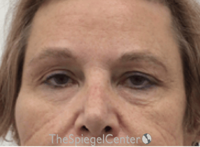 Blepharoplasty Before & After Gallery - Patient 221243 - Image 1