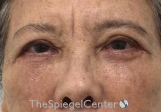 Blepharoplasty Before & After Gallery - Patient 165782 - Image 2