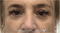 Blepharoplasty Before & After Gallery - Patient 241854 - Image 1