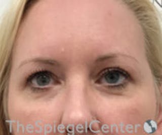 Blepharoplasty Before & After Gallery - Patient 418833 - Image 2