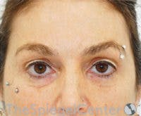 Blepharoplasty Before & After Gallery - Patient 238567 - Image 1