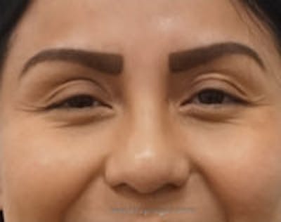 Blepharoplasty Before & After Gallery - Patient 370314 - Image 1