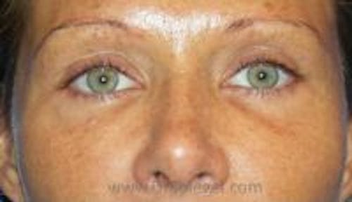Blepharoplasty Before & After Gallery - Patient 387698 - Image 1