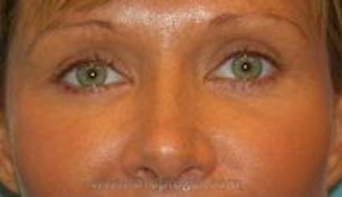 Blepharoplasty Before & After Gallery - Patient 387698 - Image 2