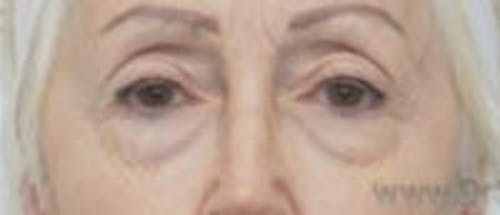 Blepharoplasty Before & After Gallery - Patient 340655 - Image 1