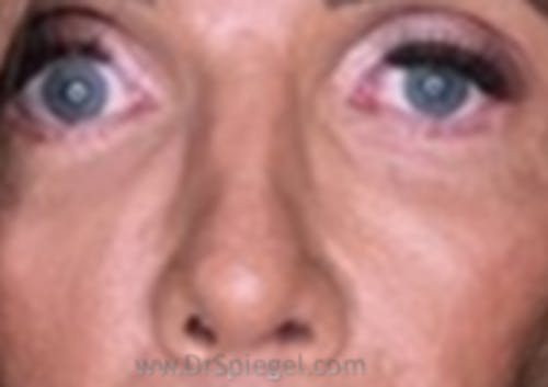 Blepharoplasty Before & After Gallery - Patient 115478 - Image 2
