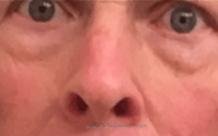 Blepharoplasty Before & After Gallery - Patient 177663 - Image 1