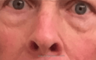 Blepharoplasty Before & After Gallery - Patient 177663 - Image 1